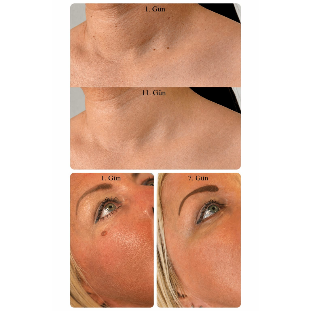 TagBuddy Kiti – Artık Cilt Lezyonlarına Son!